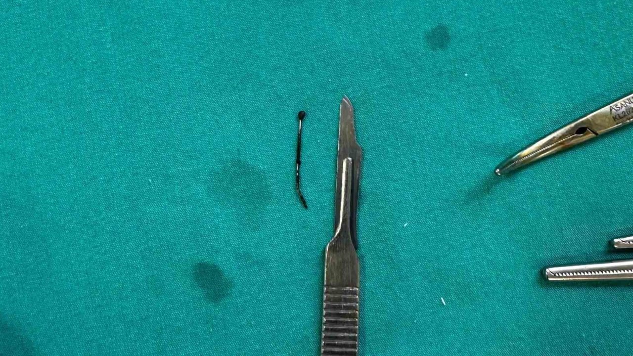 5 yaşındaki çocuğun yuttuğu toplu iğne ameliyatla çıkarıldı